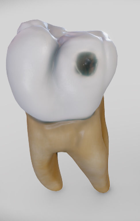 Tooth Decay Progression Dental Caries Low-poly 3D model_7