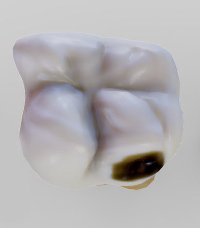 Tooth Decay Progression Dental Caries Low-poly 3D model_15