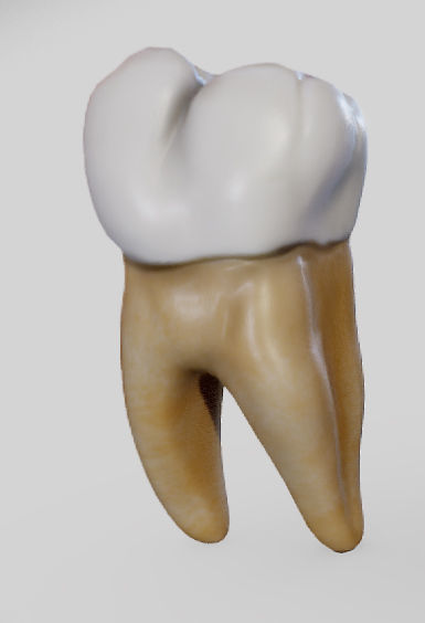 Tooth Decay Progression Dental Caries Low-poly 3D model_25