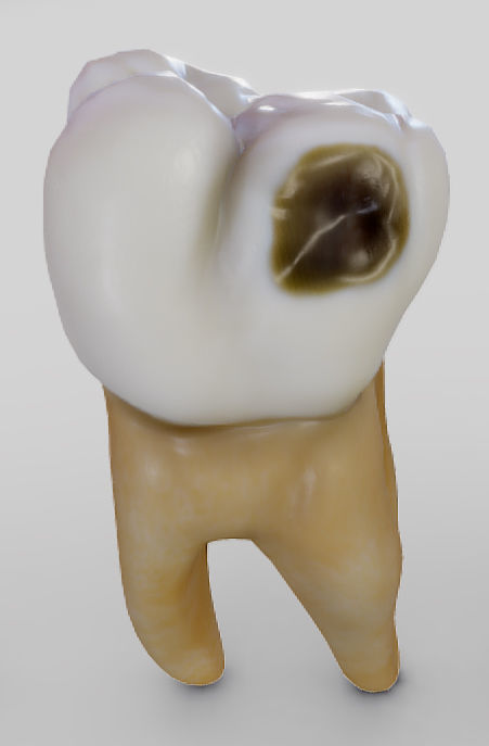 Tooth Decay Progression Dental Caries Low-poly 3D model_8