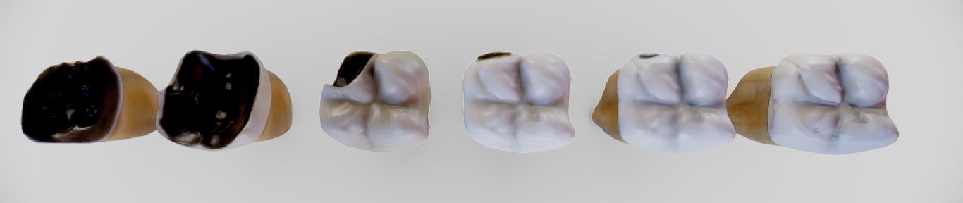 Tooth Decay Progression Dental Caries Low-poly 3D model_24