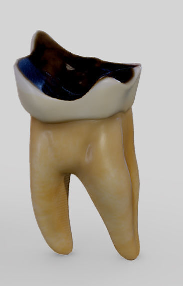 Tooth Decay Progression Dental Caries Low-poly 3D model_4