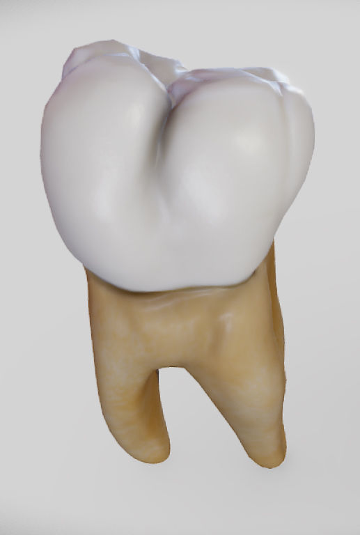 Tooth Decay Progression Dental Caries Low-poly 3D model_6