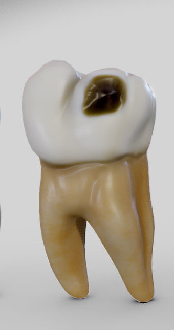Tooth Decay Progression Dental Caries Low-poly 3D model_2