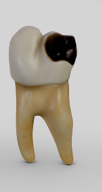 Tooth Decay Progression Dental Caries Low-poly 3D model_3