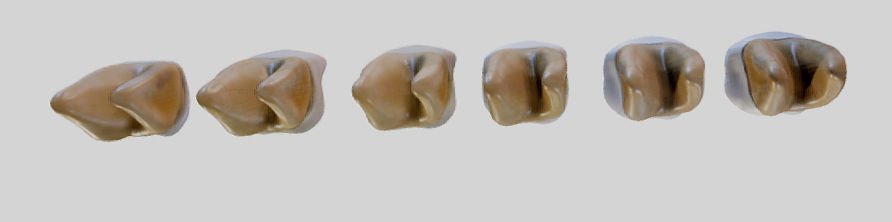 Tooth Decay Progression Dental Caries Low-poly 3D model_23