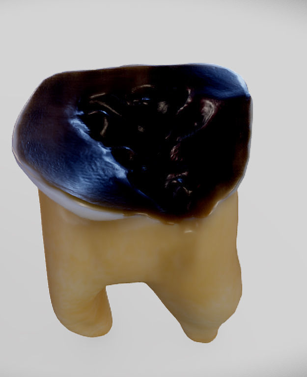 Tooth Decay Progression Dental Caries Low-poly 3D model_12