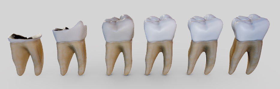 Tooth Decay Progression Dental Caries Low-poly 3D model_22