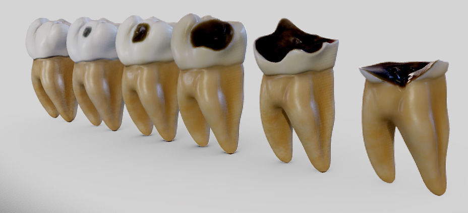 Tooth Decay Progression Dental Caries Low-poly 3D model_19