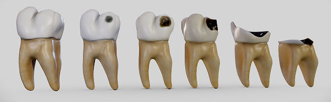 Tooth Decay Progression Dental Caries Low-poly 3D model