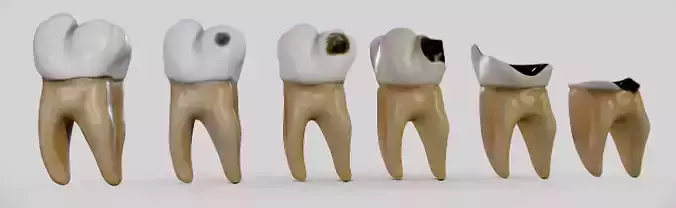 Tooth Decay Progression Dental Caries Low-poly 3D model