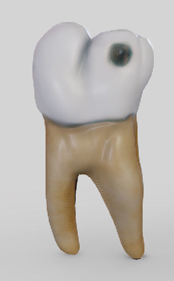 Tooth Decay Progression Dental Caries Low-poly 3D model_1
