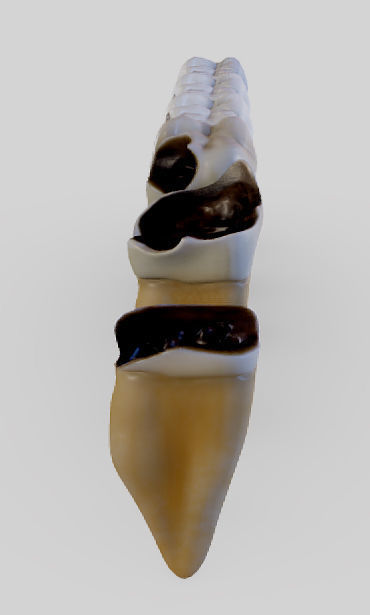 Tooth Decay Progression Dental Caries Low-poly 3D model_20