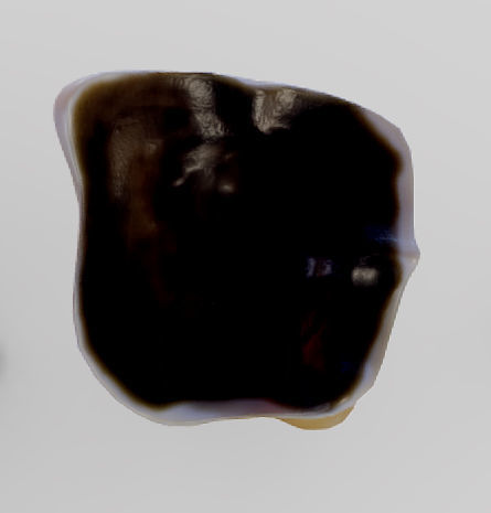 Tooth Decay Progression Dental Caries Low-poly 3D model_17