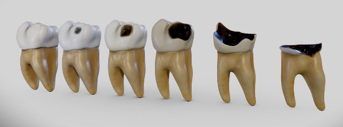 Tooth Decay Progression Dental Caries Low-poly 3D model_11
