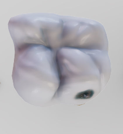 Tooth Decay Progression Dental Caries Low-poly 3D model_14