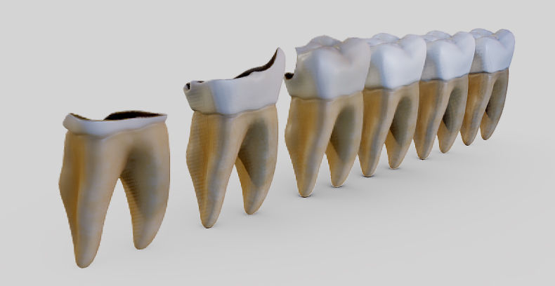 Tooth Decay Progression Dental Caries Low-poly 3D model_21