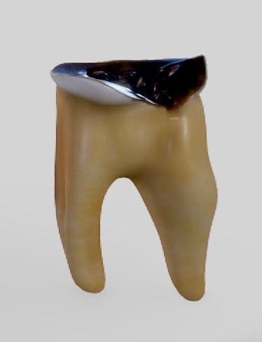 Tooth Decay Progression Dental Caries Low-poly 3D model_5