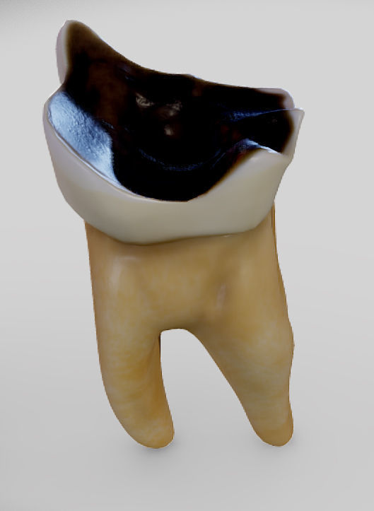 Tooth Decay Progression Dental Caries Low-poly 3D model_10