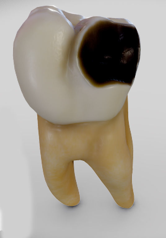 Tooth Decay Progression Dental Caries Low-poly 3D model_9
