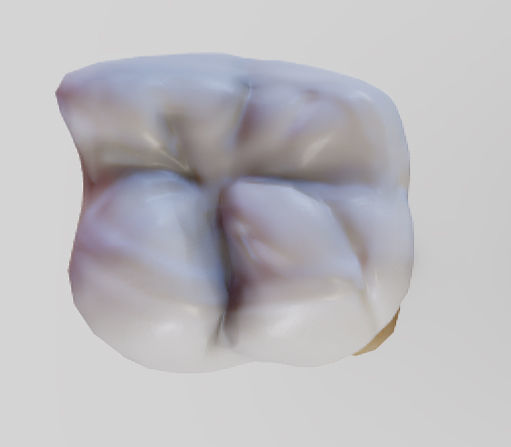 Tooth Decay Progression Dental Caries Low-poly 3D model_13