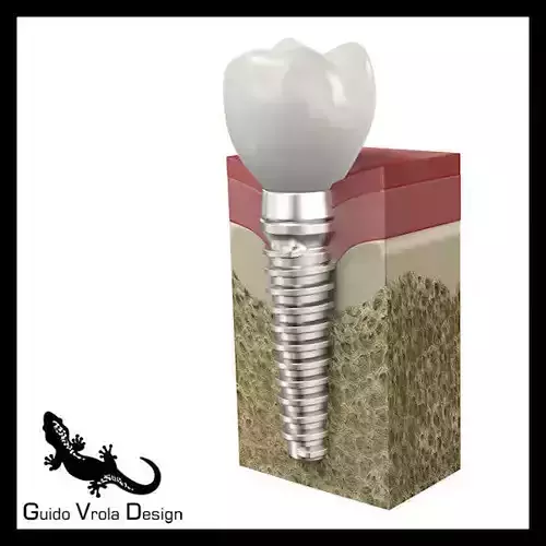 Dental Implant 3D model