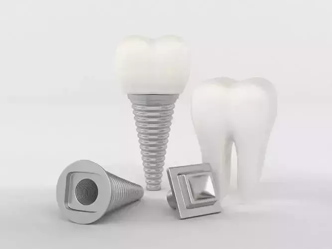 Tooth Implants 3D model