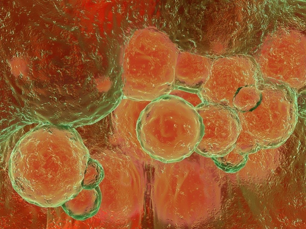 Artery hardening plaques 3D model_1