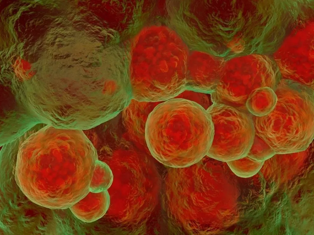 Artery hardening plaques 3D model_0