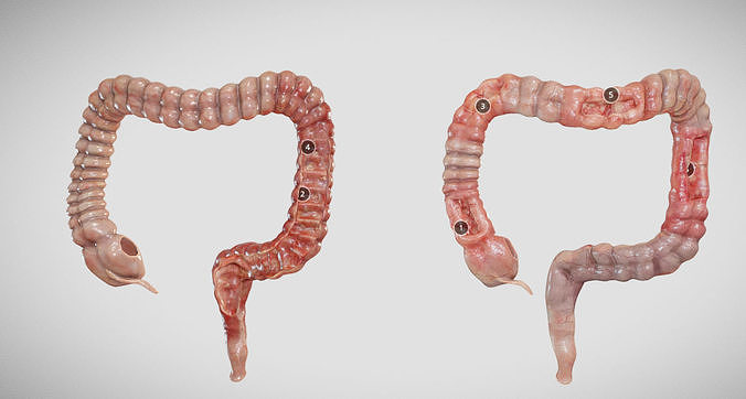 Ulcerative Colitis vs Crohn Disease Low-poly 3D model