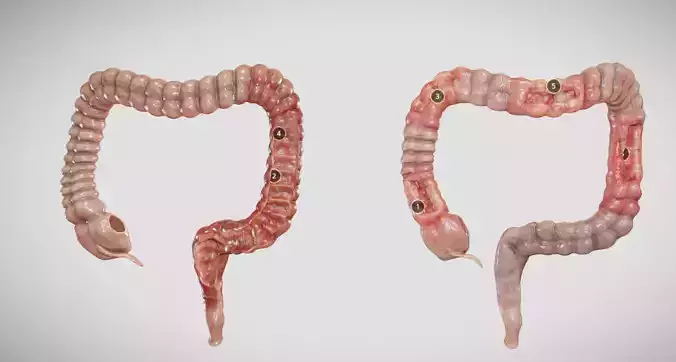 Ulcerative Colitis vs Crohn Disease Low-poly 3D model