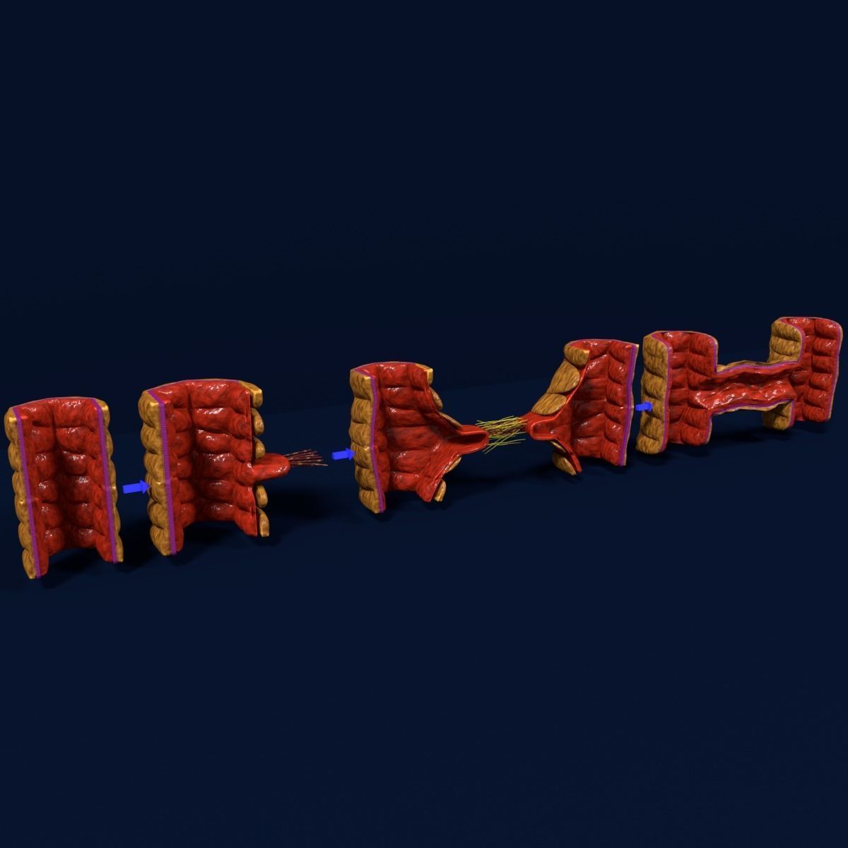 Angiogenesis human  3D model_8
