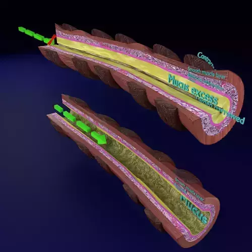 Asthma bronchiole obstruction 3D model