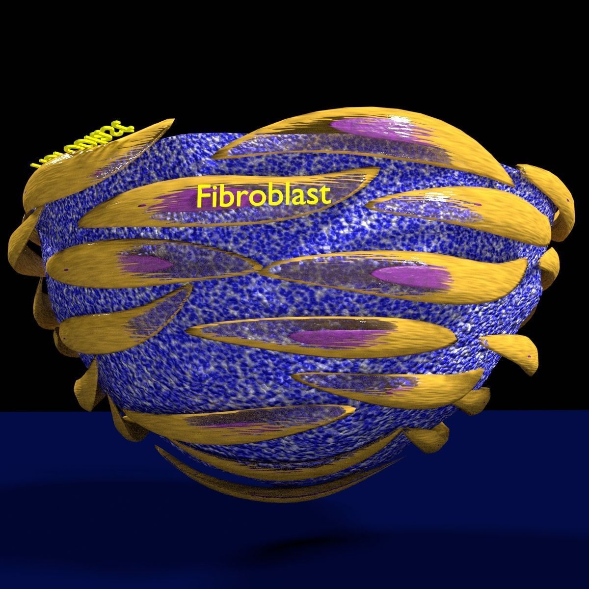 Caseating granuolma tuberculosis labelled 3D model_1