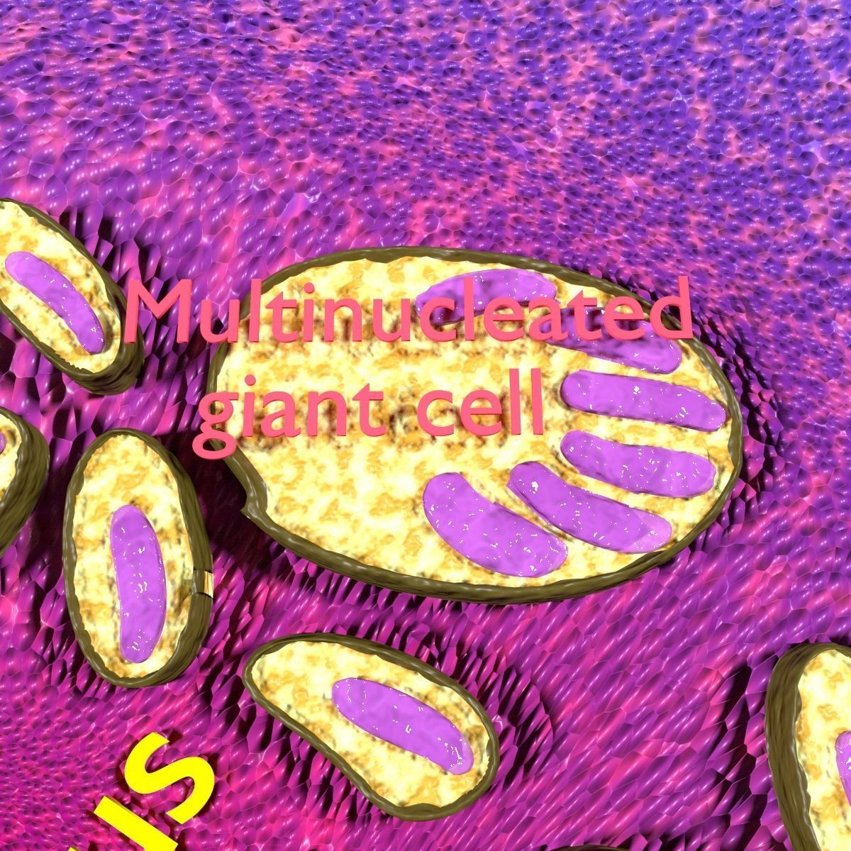 Caseating granuolma tuberculosis labelled 3D model_3