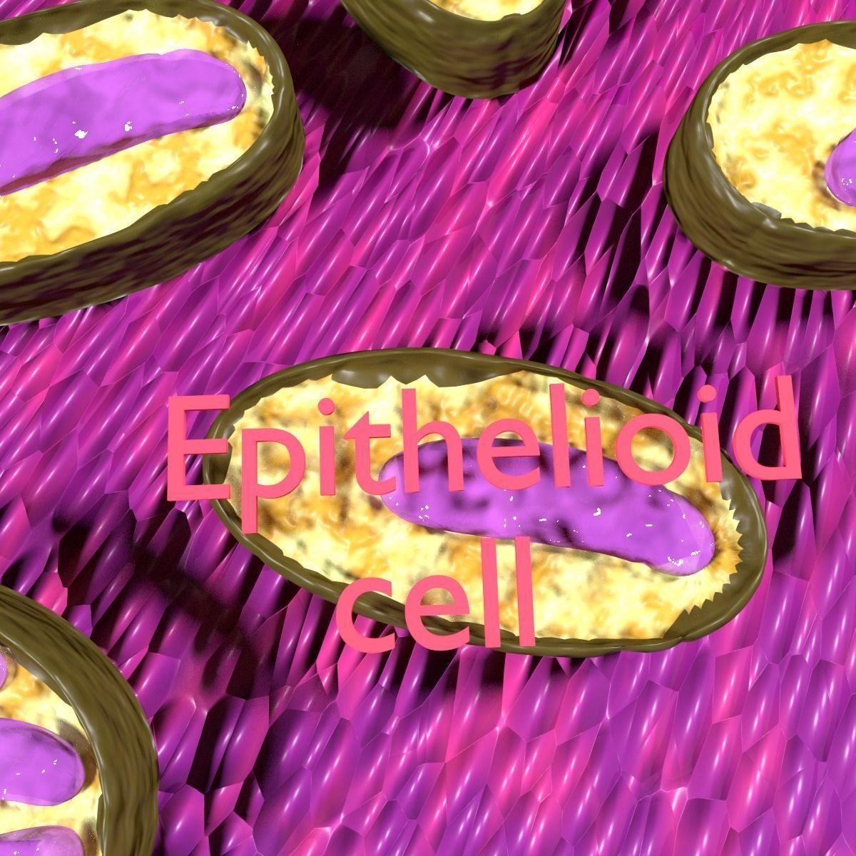 Caseating granuolma tuberculosis labelled 3D model_4