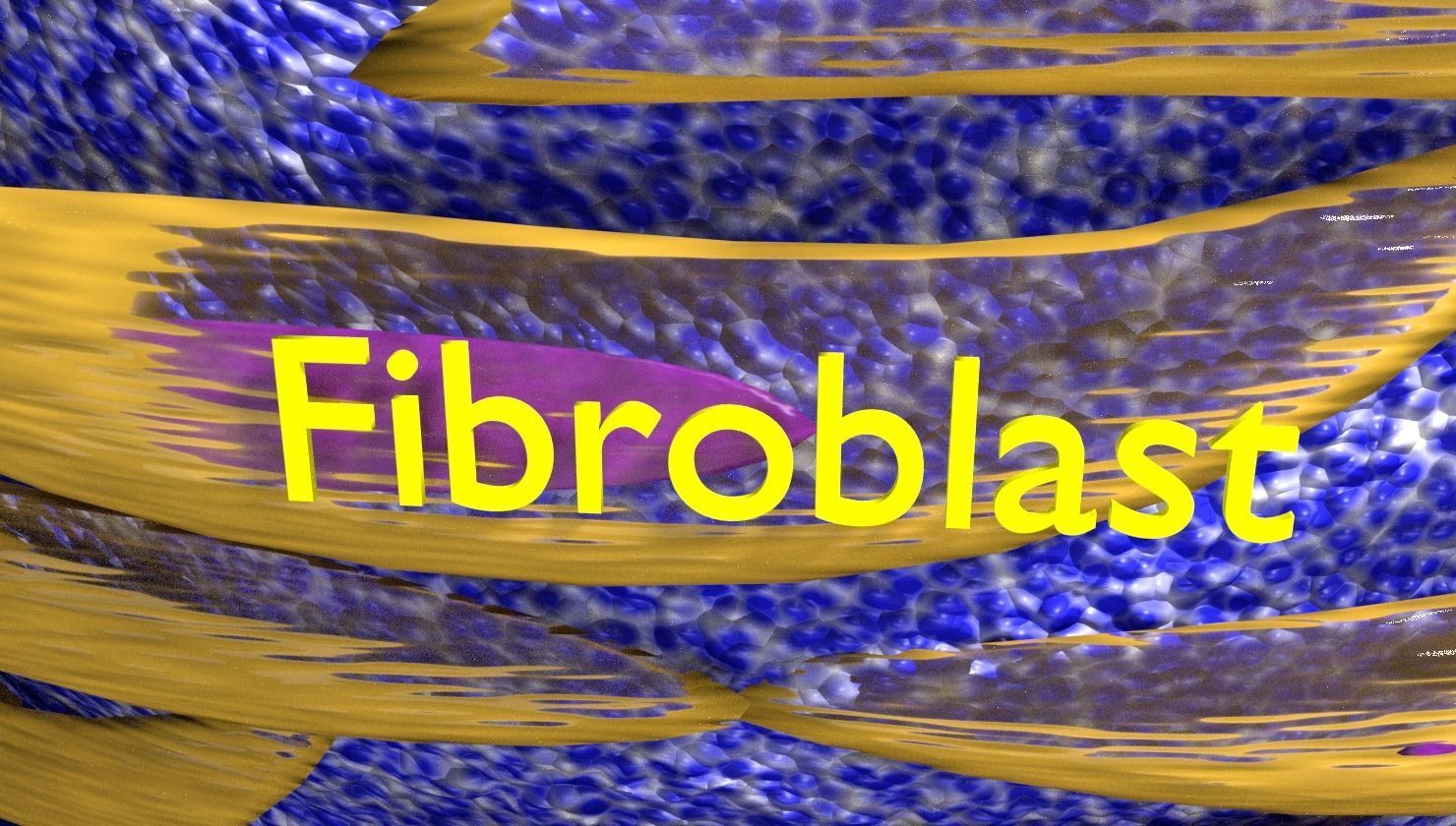 Caseating granuolma tuberculosis labelled 3D model_7