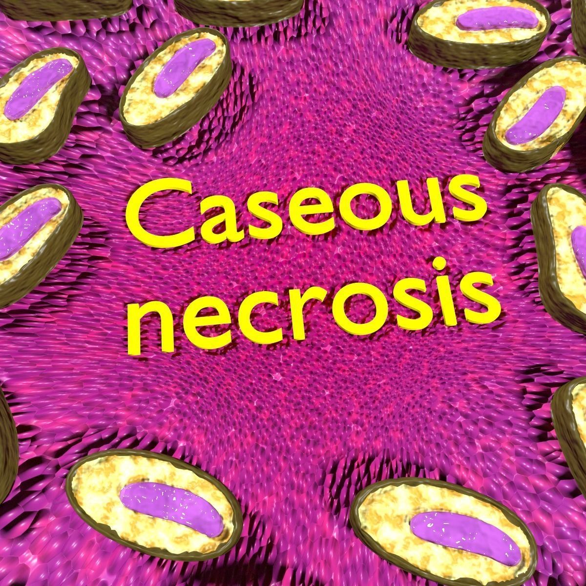 Caseating granuolma tuberculosis labelled 3D model_2