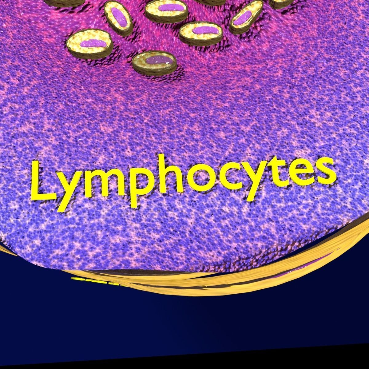 Caseating granuolma tuberculosis labelled 3D model_5