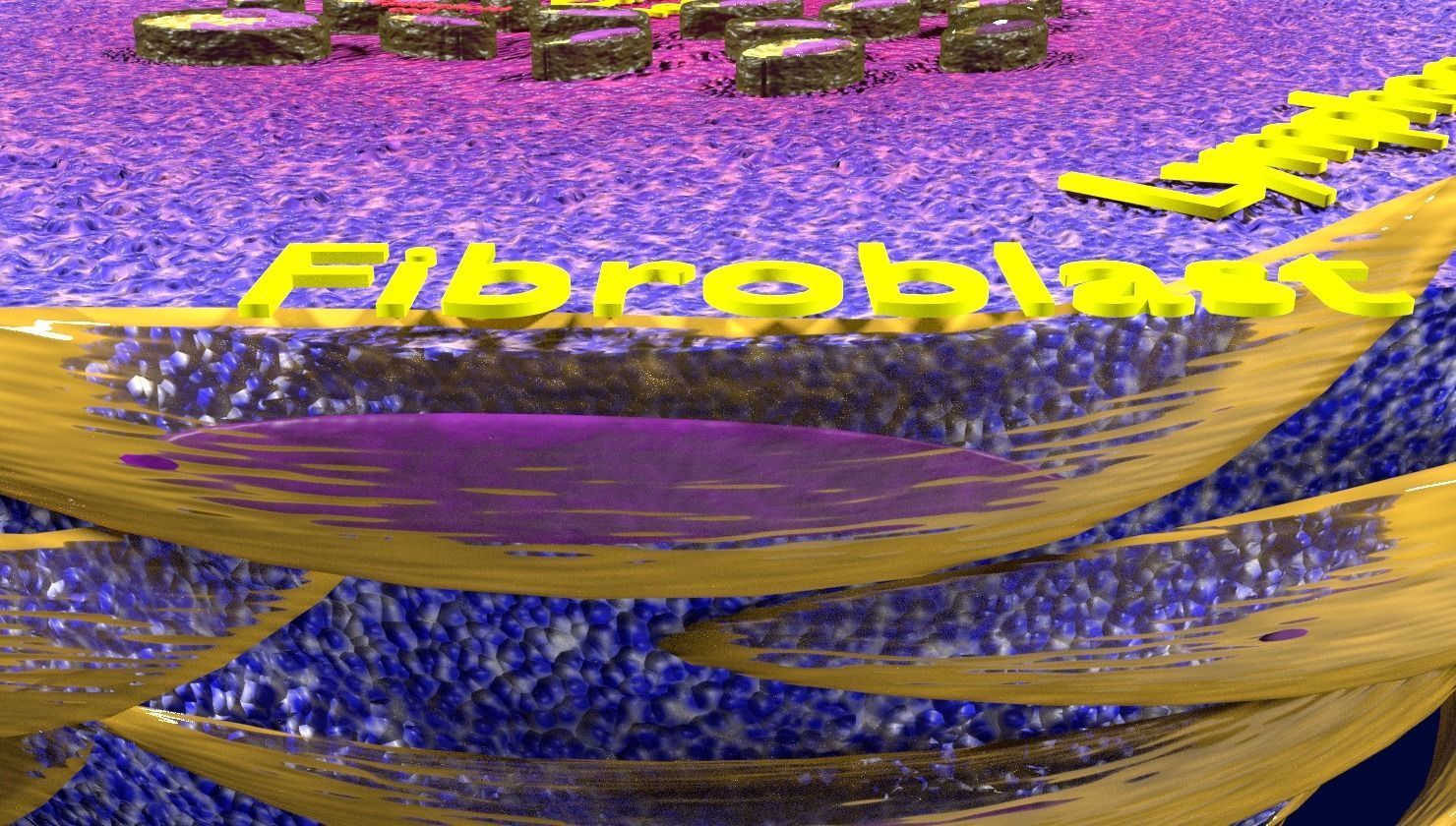 Caseating granuolma tuberculosis labelled 3D model_6