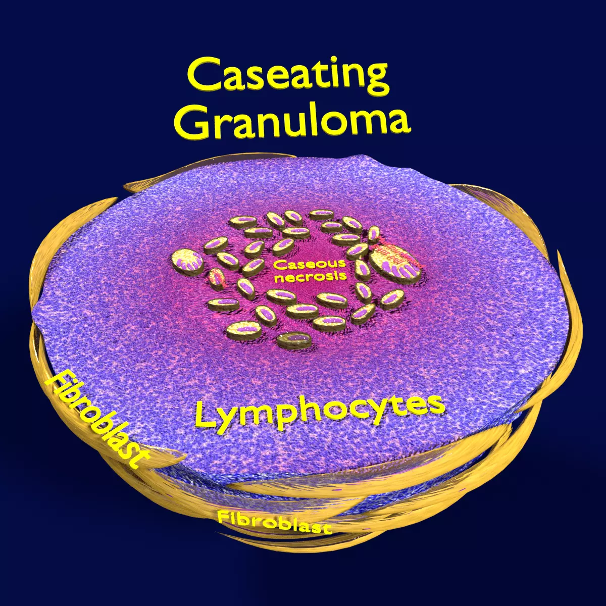 Caseating granuolma tuberculosis labelled 3D model_0