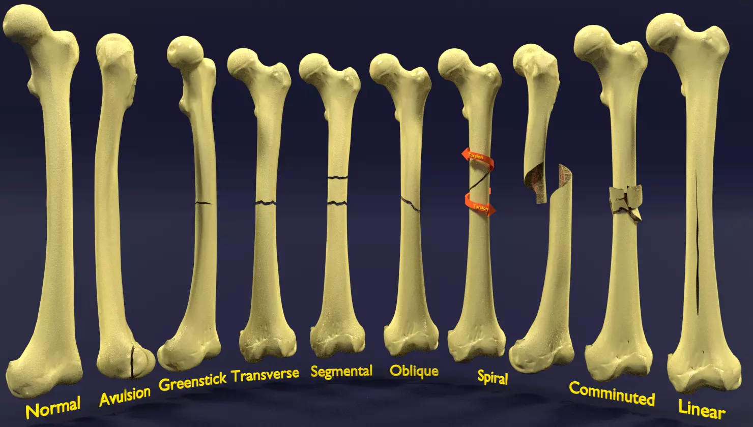 Fracture types labelled 3D model_0