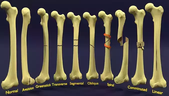 Fracture types labelled 3D model