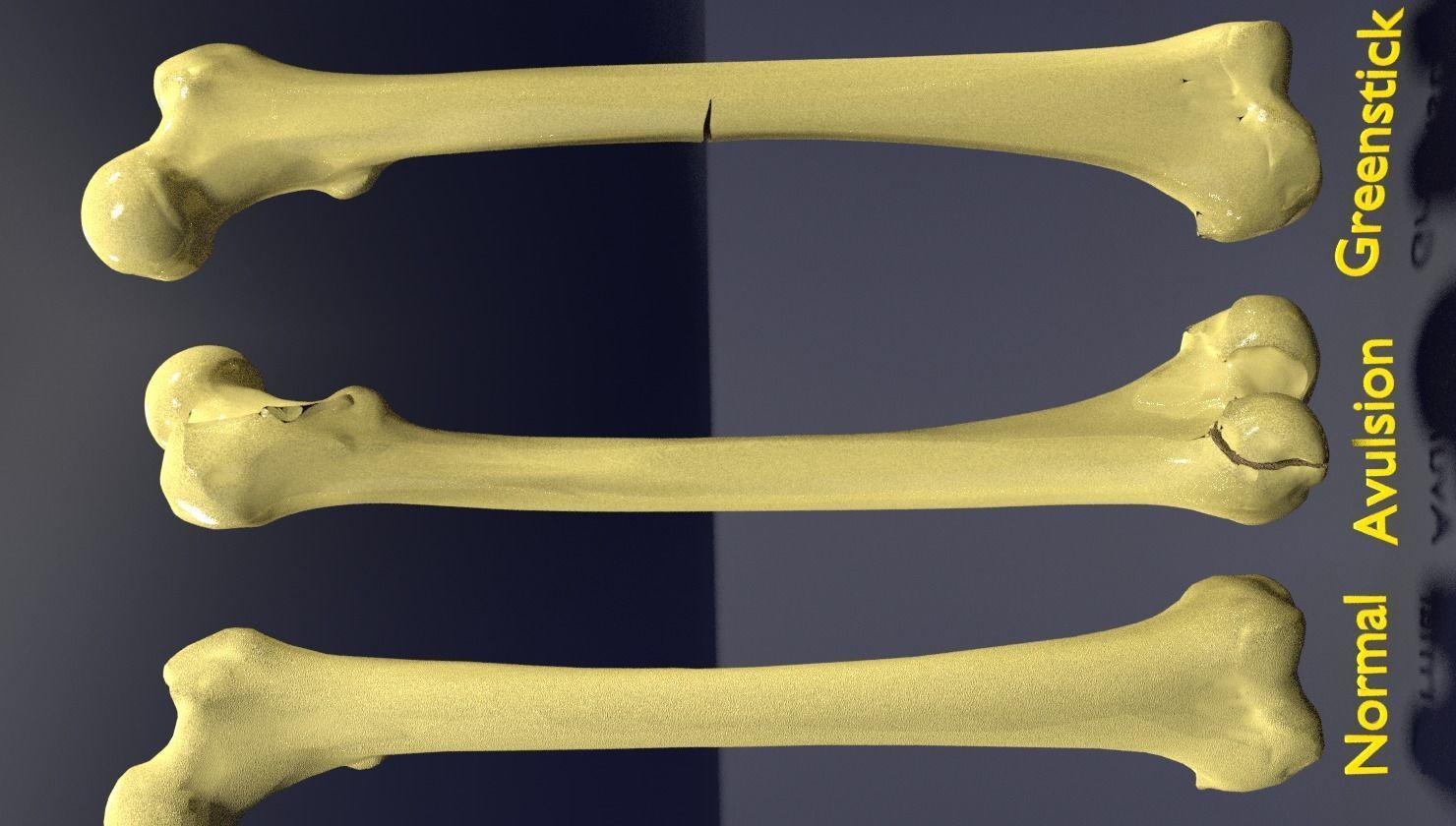 Fracture types labelled 3D model_4