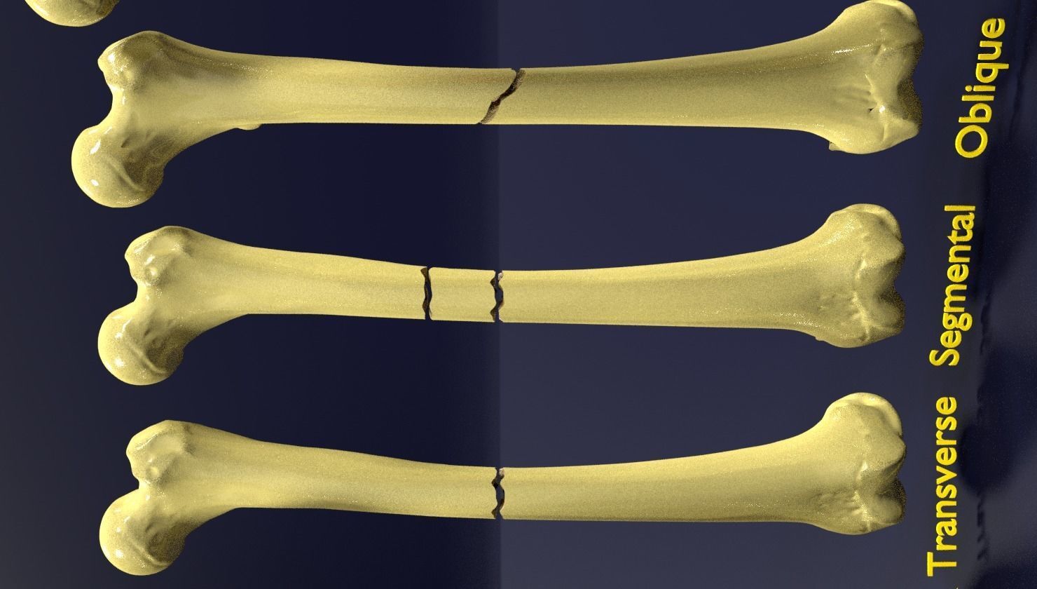 Fracture types labelled 3D model_5