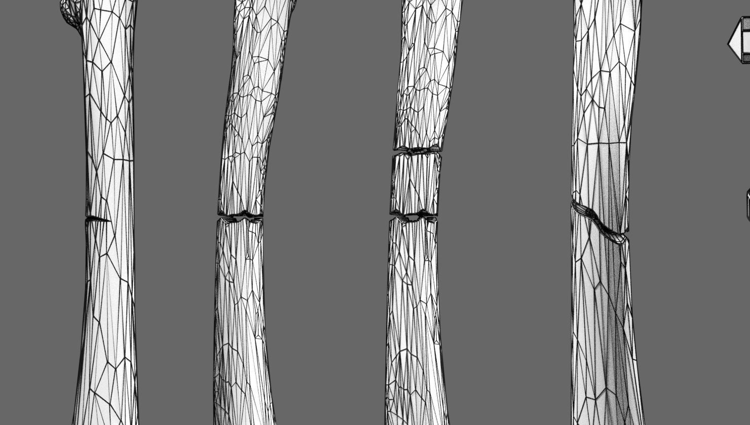 Fracture types labelled 3D model_12
