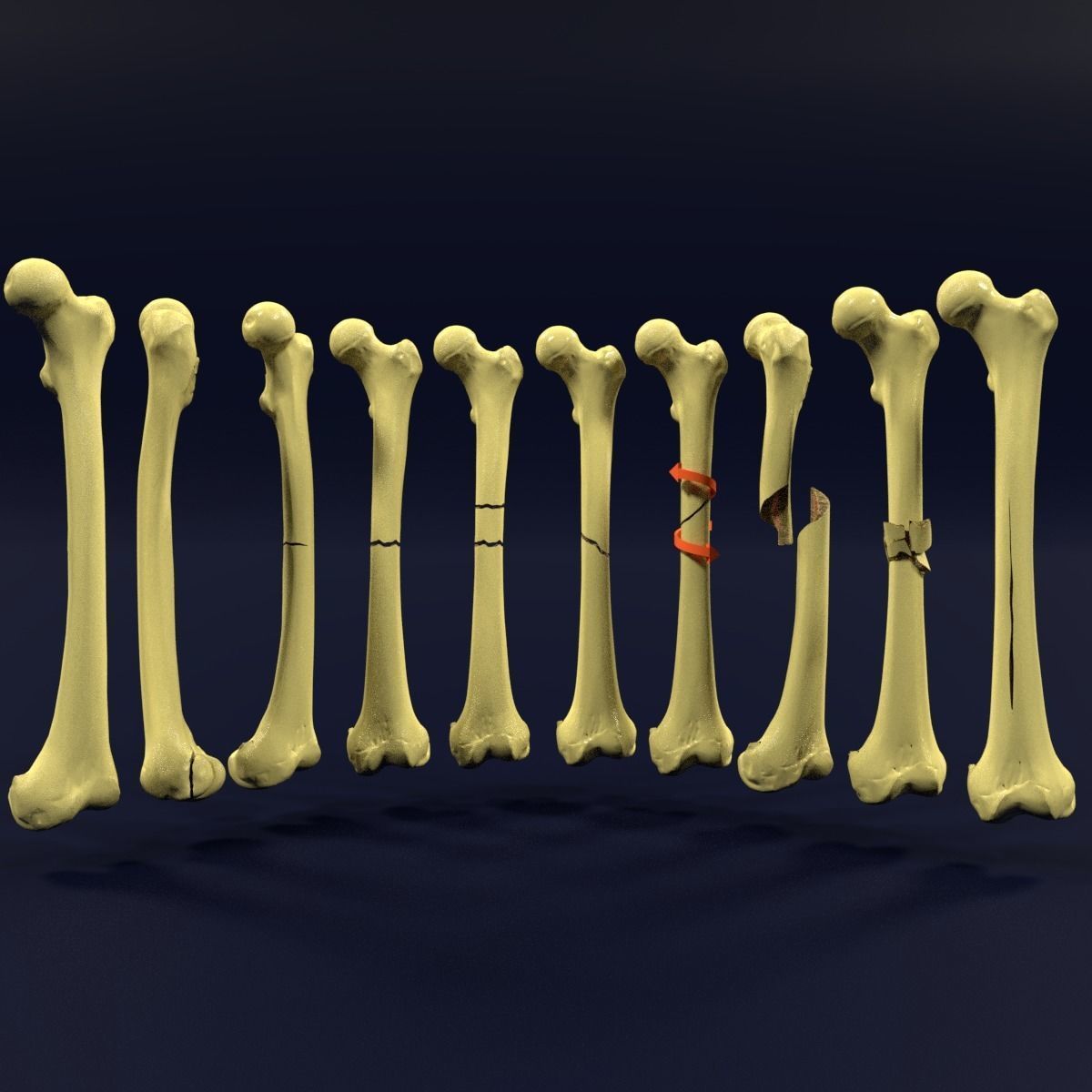 Fracture types labelled 3D model_3
