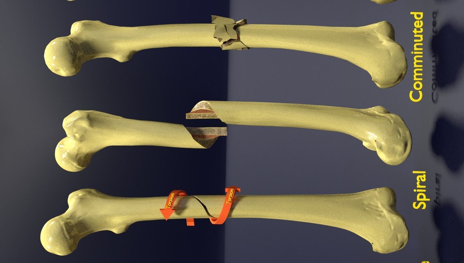 Fracture types labelled 3D model_6