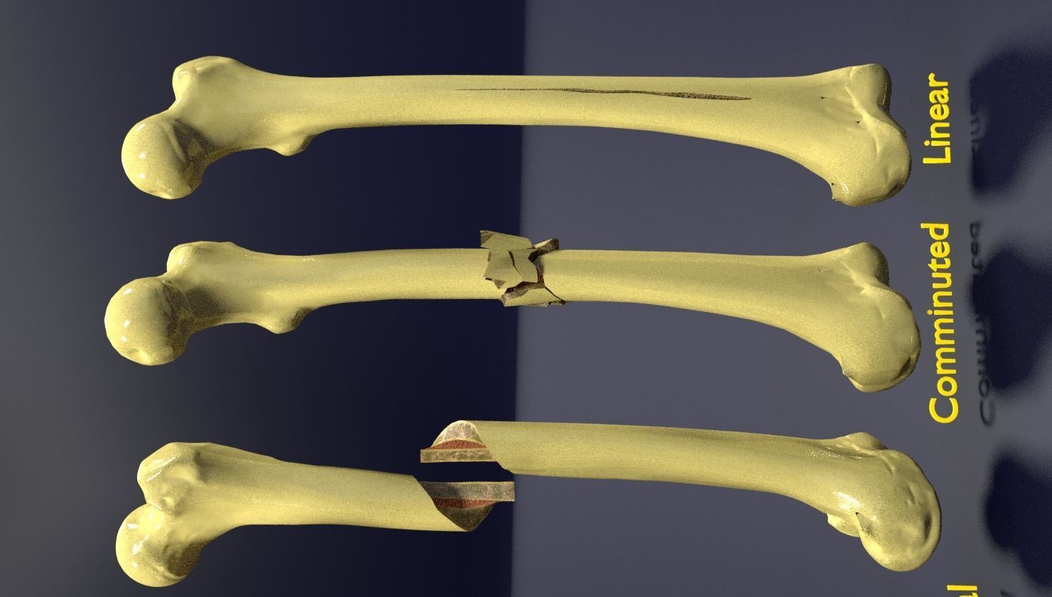 Fracture types labelled 3D model_7