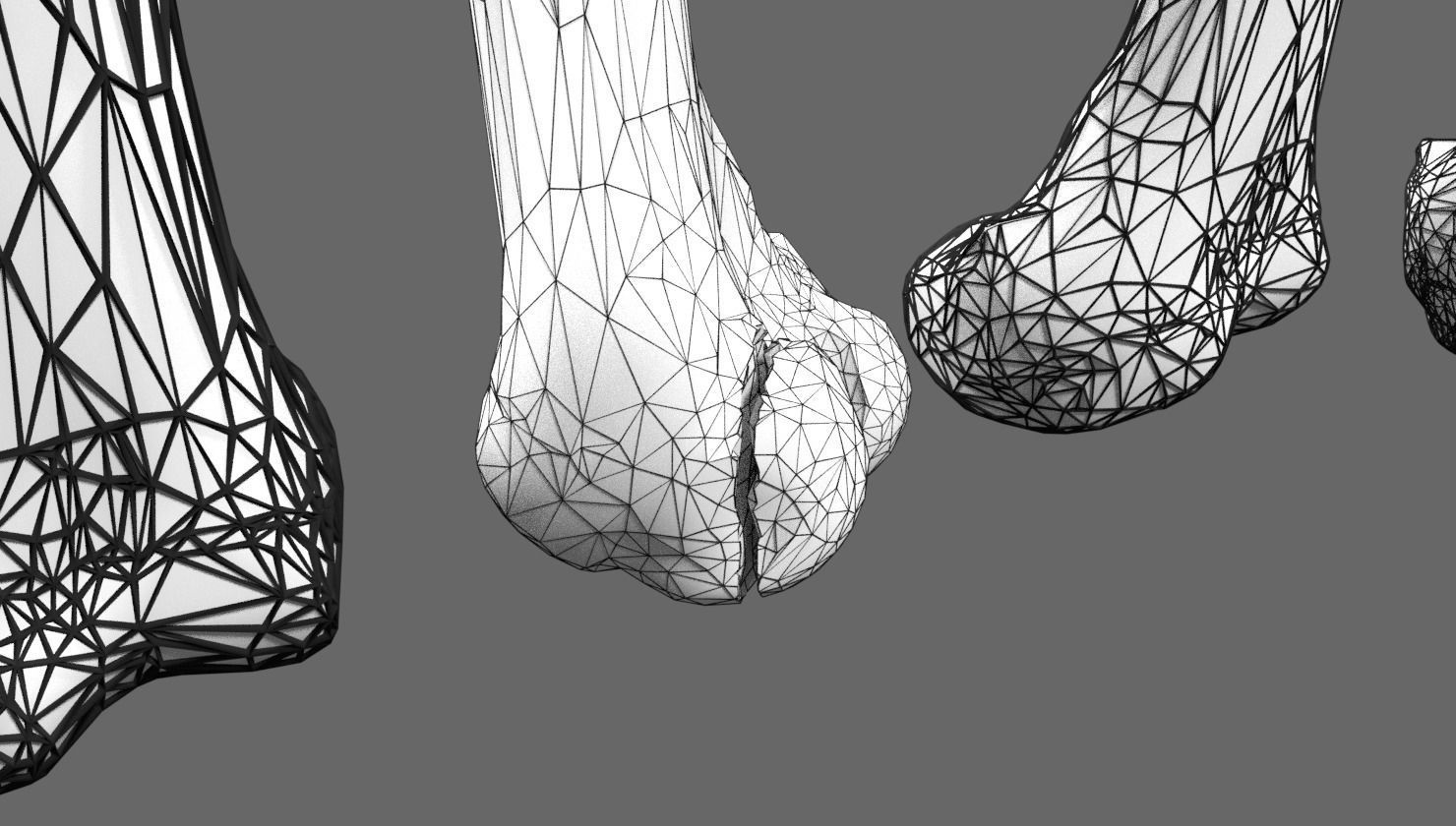 Fracture types labelled 3D model_13